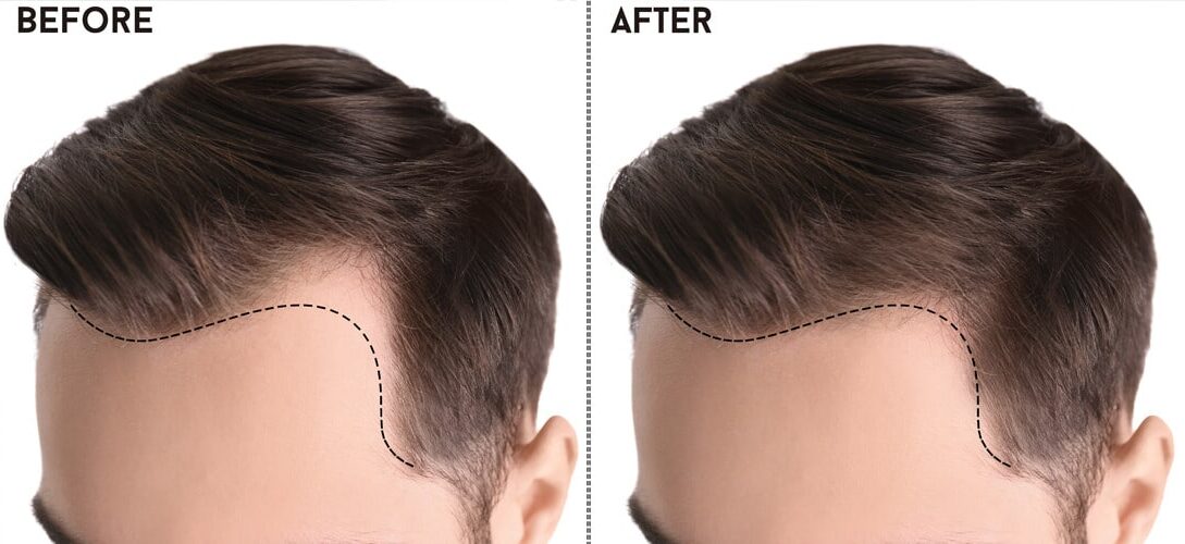 Hair Transplant in Pakistan