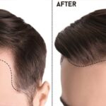 Hair Transplant in Pakistan