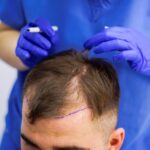 تكلفة زراعة الشعر