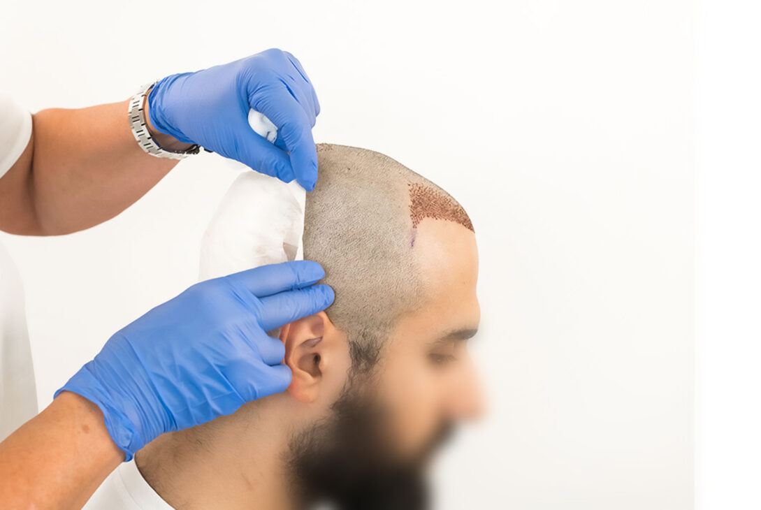 تكلفة زراعة الشعر