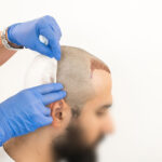 تكلفة زراعة الشعر