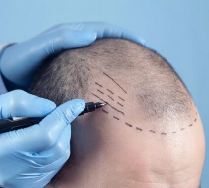 تكلفة زراعة الشعر في دبي