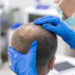 تكلفة زراعة الشعر في دبي