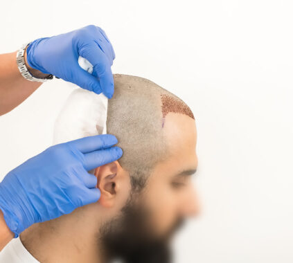 تكلفة زراعة الشعر في دبي