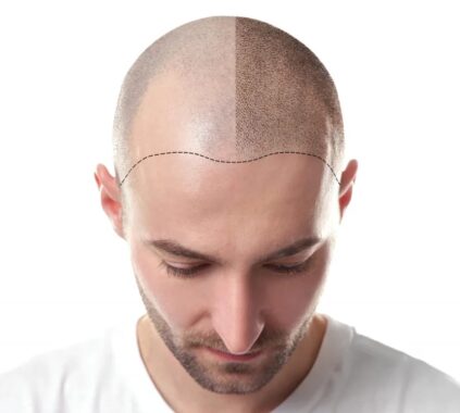 Hair transplant cost