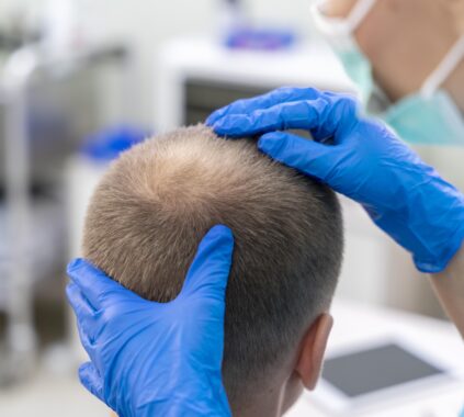 تكلفة زراعة الشعر في دبي