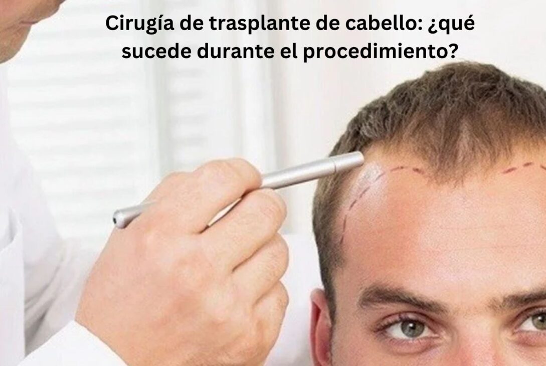 Transplante de cabello